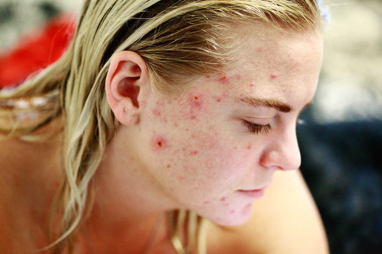 tanmucare Ache /Pimples Gua Sha Techniques 