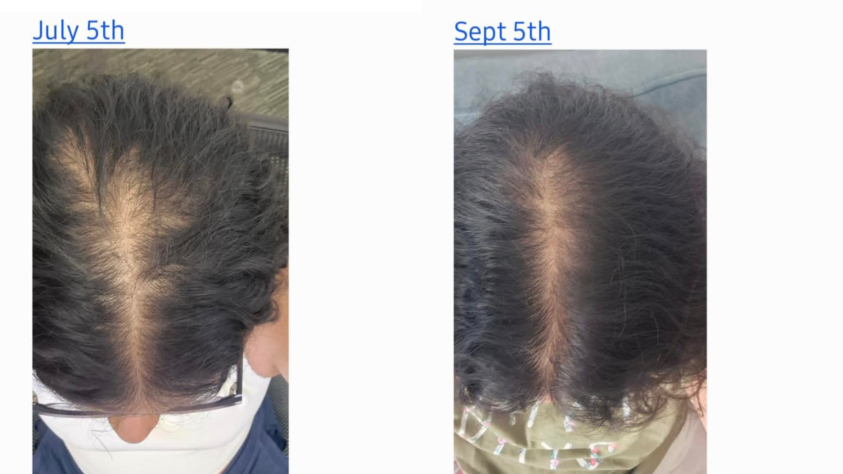Scalp Gua Sha: From thinning hair to visible growth in just weeks ✨